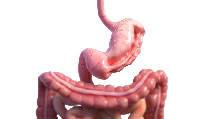 Anatomical 3D render of the stomach after endoscopic sleeve gastroplasty — internal sutures fold the greater curvature and reduce stomach volume.